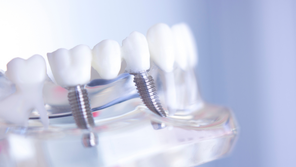 Zobu implantu aprūpe